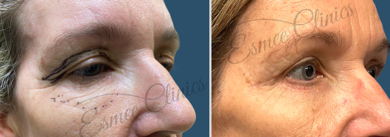 Before and After img